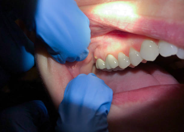 Best Emergency Wisdom Teeth Removal in Essex Village, CT